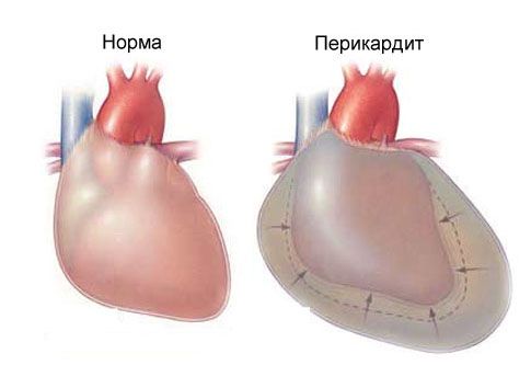 急性心膜炎および左胸の胸痛