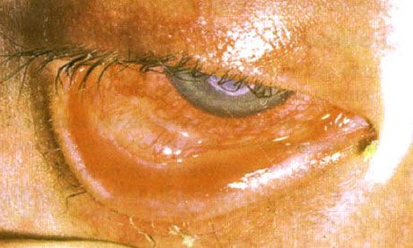 スティーブンス・ジョンソン症候群。壊死を伴う両眼の剥離性結膜炎。重度の角膜炎により角膜に瘢痕が生じた。さらにドライアイ症候群が加わり、状況はより複雑化した。