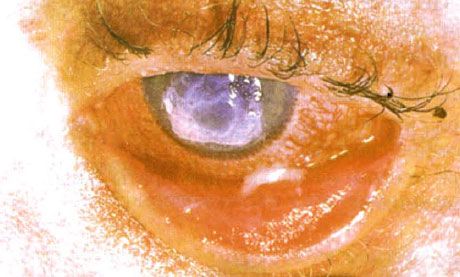 スティーブンス・ジョンソン症候群。壊死を伴う両眼の剥離性結膜炎。重度の角膜炎により角膜に瘢痕が生じた。さらにドライアイ症候群が加わり、状況はより複雑化した。