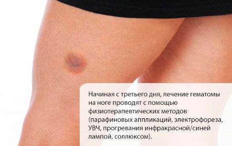 脚の上の血腫の治療