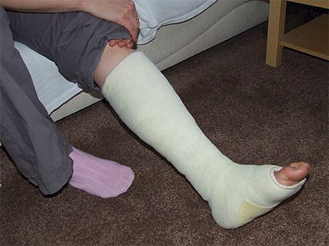 足の骨折に効く家庭療法