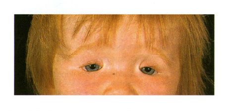 ゴールデン症候群の小児の眼瞼の両側コロボーマ。 左側のアイスリットの閉鎖