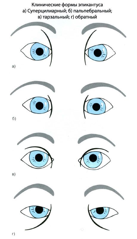 エピンツフスの臨床形態。 a）甲状腺、b）眼瞼、c）足底、d）逆位